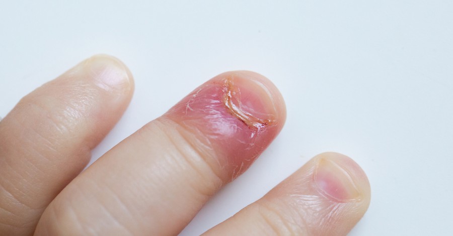 Бактериална инфекция на ноктите на бебето - какво трябва да знаем?