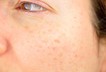 Woman pregnancy face blemish spots skin 143994293 l 2015