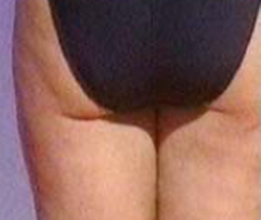 Cellulite 20after