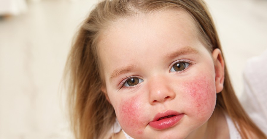 Σε ποιες τροφές παρουσιάζουν συχνά τα παιδιά αλλεργική αντίδραση; 