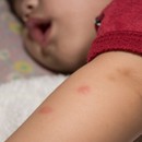Ухапвания от комари при бебетата