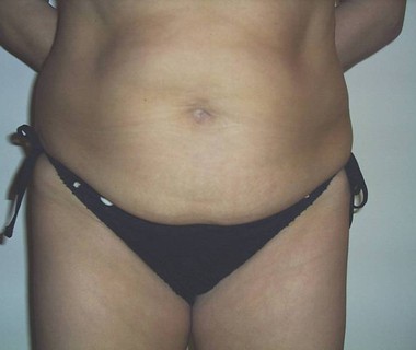 Targetd fat reduction 4 before