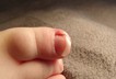 Baby s ingrown toenail