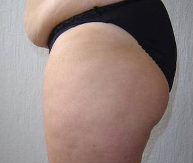 Targetd fat reduction 2. before