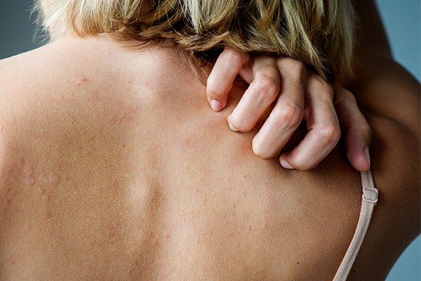 How To Get Rid Of Annoying Stings And Enjoy Your S