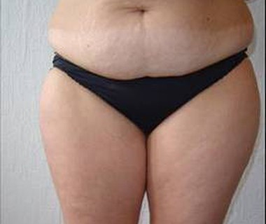 Targetd fat reduction 1. before
