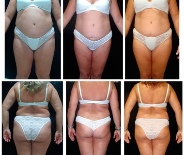 Before after 18