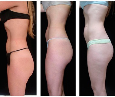 Before after 12