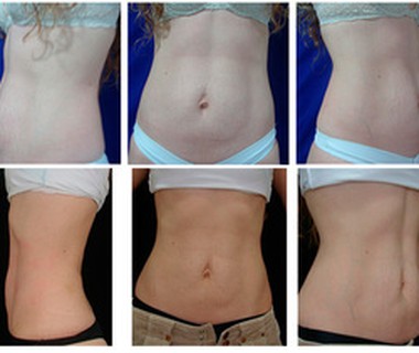 Square before after 9