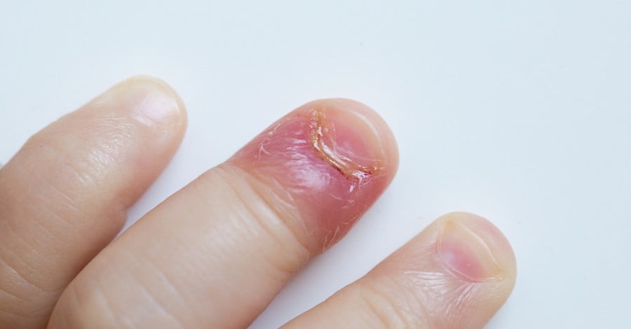 Бактериална инфекция на ноктите на бебето - какво трябва да знаем?