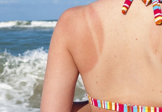 Sunburns How to treat them properly