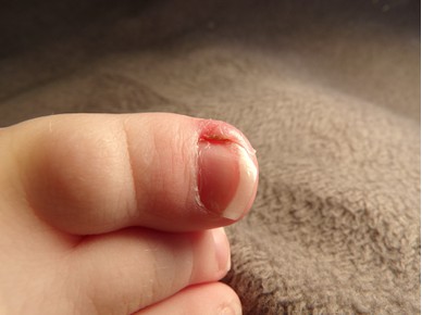 Враснал нокът на пръста на бебето - какво да направим