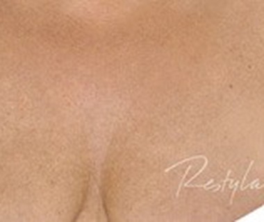 Decolletage after