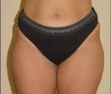 Targetd fat reduction 1. after