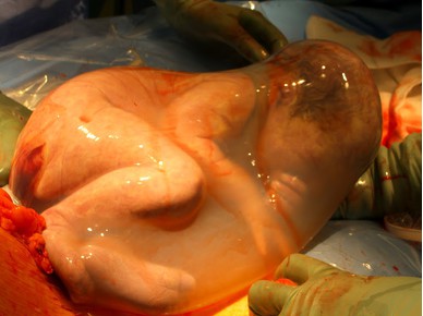 Miracolul nașterii: Bebeluși născuți în sacul amniotic 