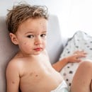 Ανεμοβλογιά, μια από τις πιο κοινές παιδικές αρρώστιες 