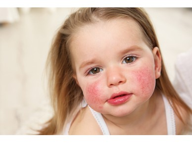 Σε ποιες τροφές παρουσιάζουν συχνά τα παιδιά αλλεργική αντίδραση; 