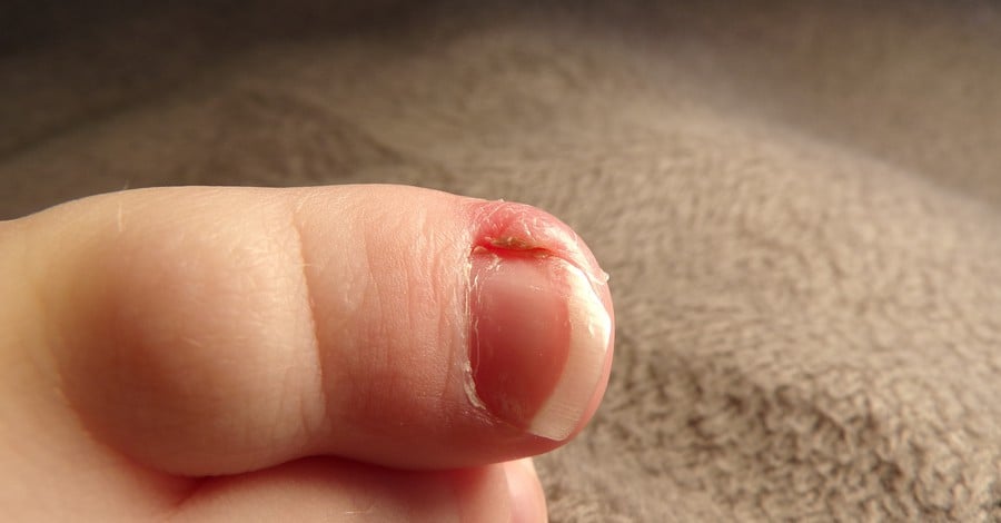 Враснал нокът на пръста на бебето - какво да направим