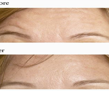 Botox 8