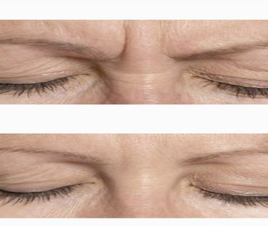 Botox 1